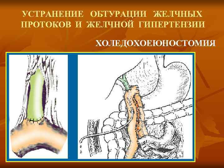 УСТРАНЕНИЕ ОБТУРАЦИИ ЖЕЛЧНЫХ ПРОТОКОВ И ЖЕЛЧНОЙ ГИПЕРТЕНЗИИ ХОЛЕДОХОЕЮНОСТОМИЯ 