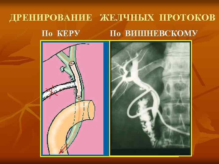 ДРЕНИРОВАНИЕ ЖЕЛЧНЫХ ПРОТОКОВ По КЕРУ По ВИШНЕВСКОМУ 