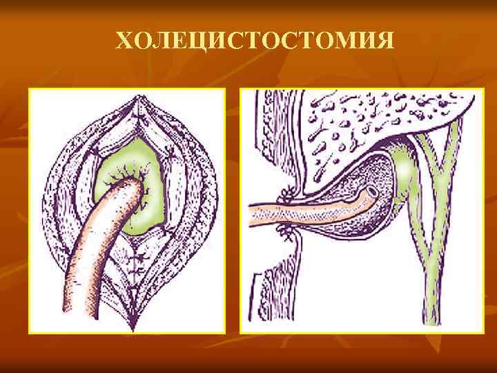 ХОЛЕЦИСТОСТОМИЯ 