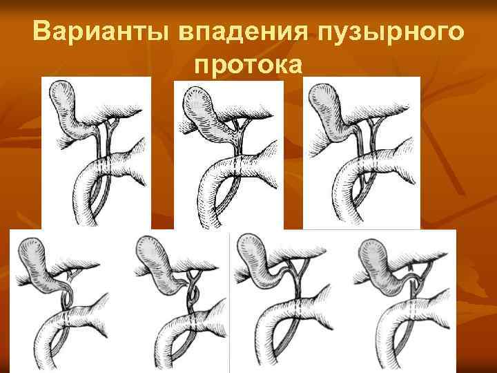 Варианты впадения пузырного протока 