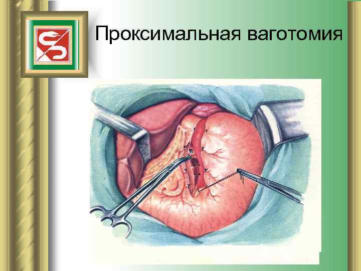 Проксимальная ваготомия 