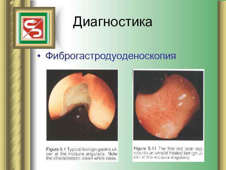 Диагностика • Фиброгастродуоденоскопия 