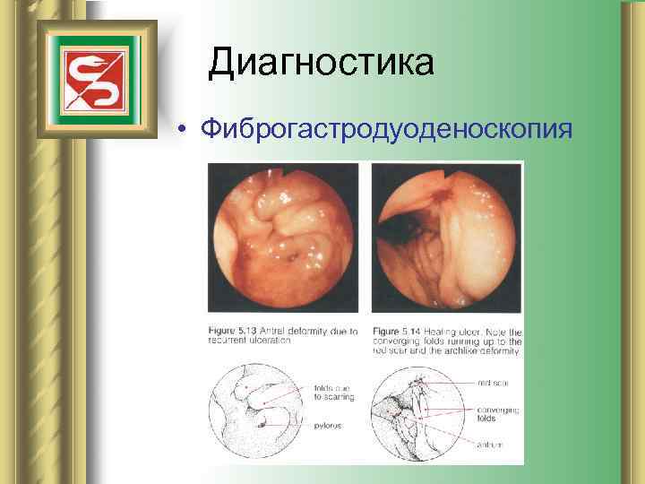 Диагностика • Фиброгастродуоденоскопия 