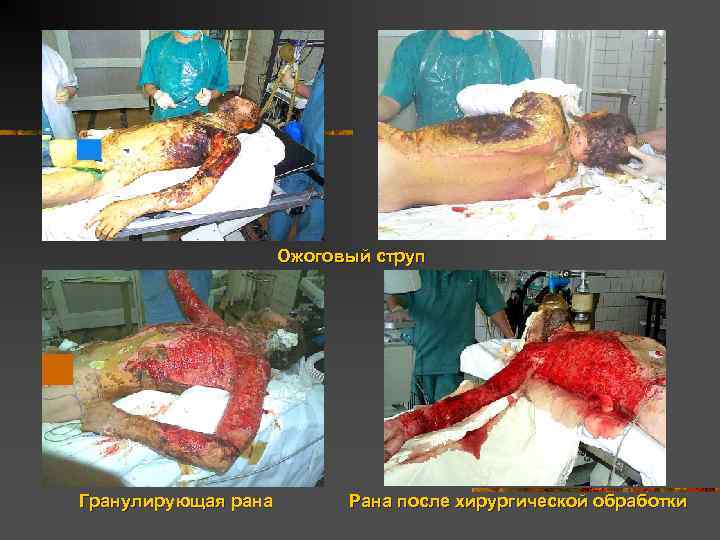 Ожоговый струп Гранулирующая рана Рана после хирургической обработки 