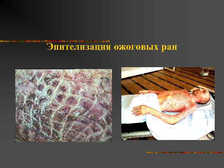 Эпителизация ожоговых ран 