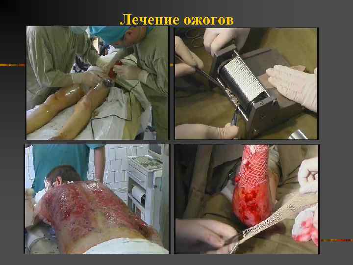 Лечение ожогов 