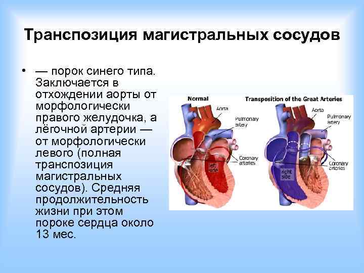 Транспозиция магистральных сосудов • — порок синего типа. Заключается в отхождении аорты от морфологически