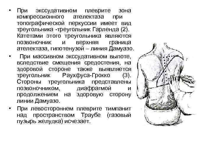  • При экссудативном плеврите зона компрессионного ателектаза при топографической перкуссии имеет вид треугольника