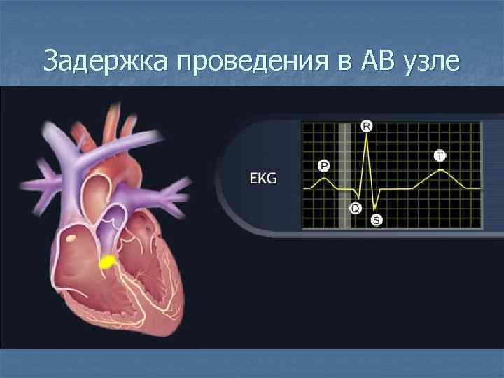 Задержка проведения в АВ узле 