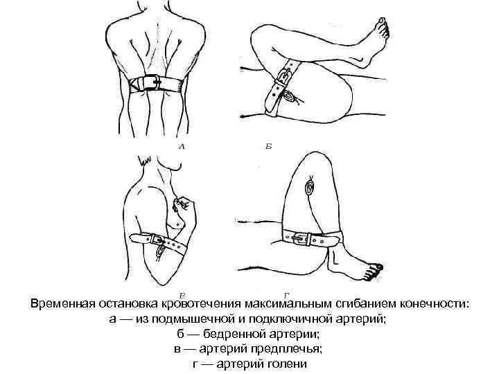 Сонно подключичное шунтирование схема операции