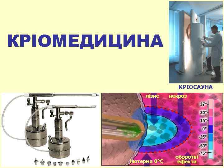 КРІОМЕДИЦИНА КРІОСАУНА лізис некроз ізотерма 0°С оборотні ефекти 