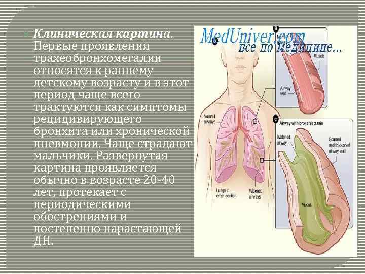  Клиническая картина. Первые проявления трахеобронхомегалии относятся к раннему детскому возрасту и в этот