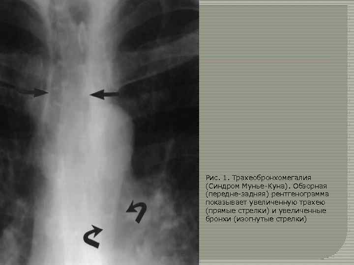 Рис. 1. Трахеобронхомегалия (Синдром Мунье-Куна). Обзорная (передне-задняя) рентгенограмма показывает увеличенную трахею (прямые стрелки) и