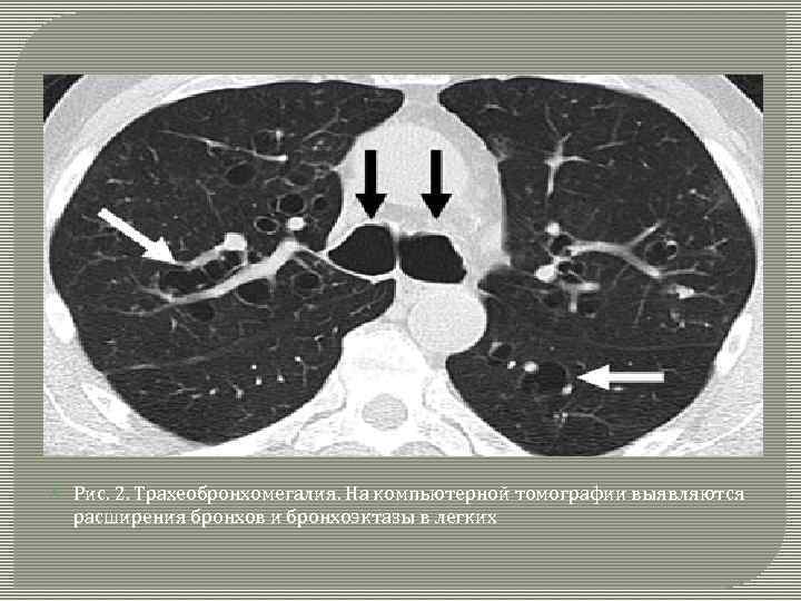  Рис. 2. Трахеобронхомегалия. На компьютерной томографии выявляются расширения бронхов и бронхоэктазы в легких