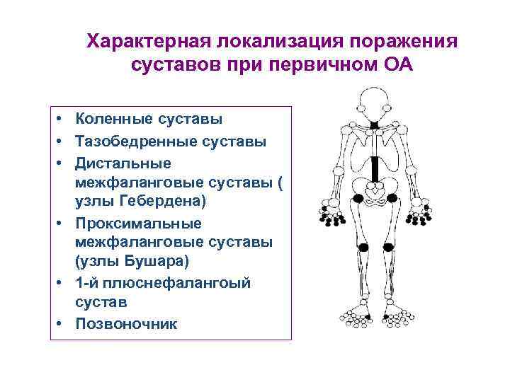 Характерная локализация поражения суставов при первичном ОА • Коленные суставы • Тазобедренные суставы •