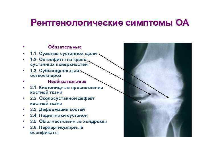 Рентгенологические симптомы ОА • • • Обязательные 1. 1. Сужение суставной щели 1. 2.