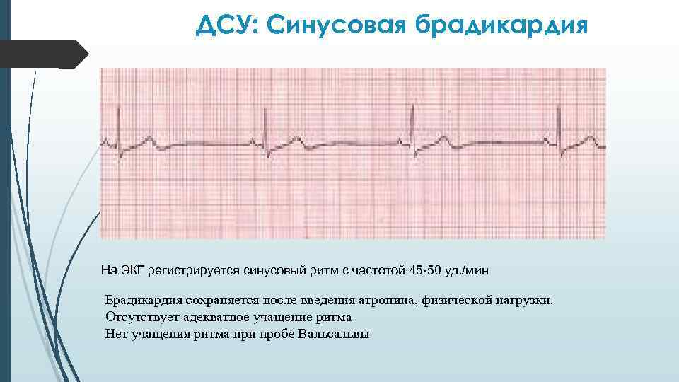ДCУ: Синусовая брадикардия На ЭКГ регистрируется синусовый ритм с частотой 45 -50 уд. /мин