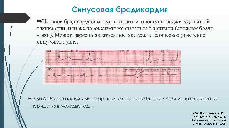 Синусовая брадикардия На фоне брадикардии могут появляться приступы наджелудочковой тахикардии, или же пароксизмы мерцательной