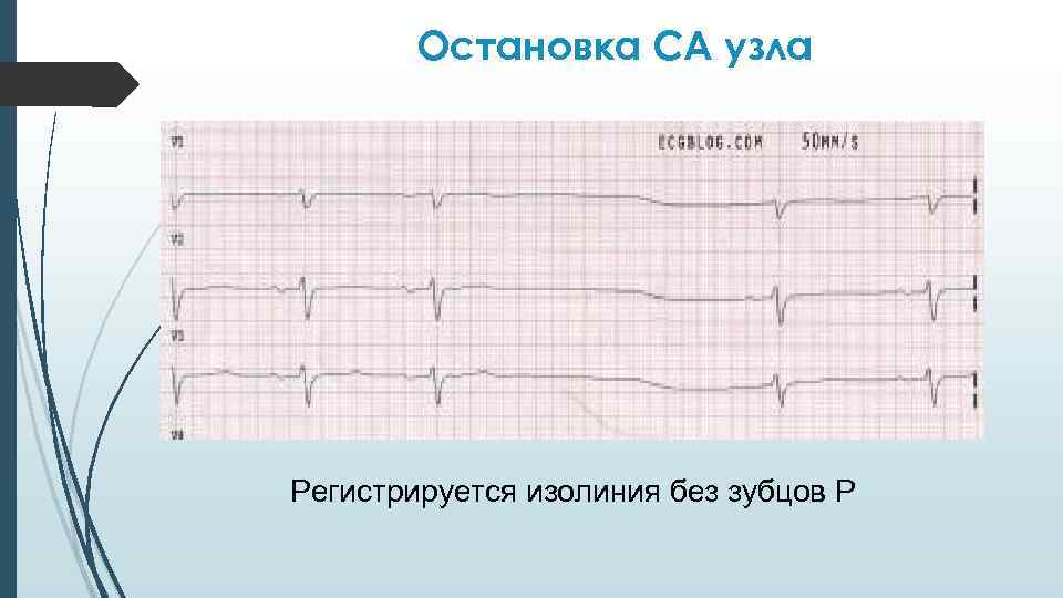Остановка СА узла Регистрируется изолиния без зубцов Р 