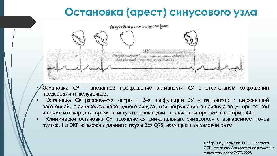 Остановка (арест) синусового узла § Остановка СУ – внезапное прекращение активности СУ с отсутствием