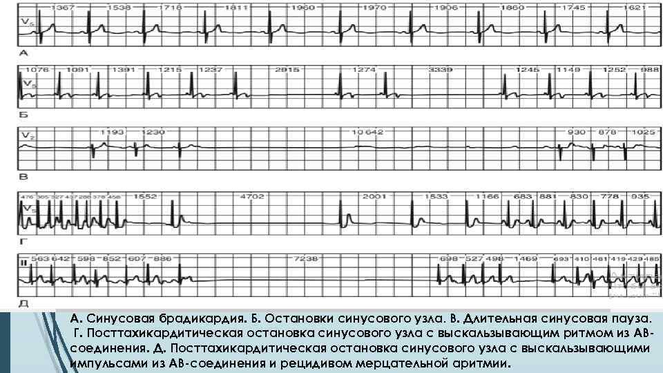 Синусовая брадикардия карта вызова