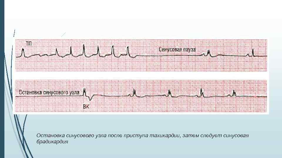Остановка синусового узла после приступа тахикардии, затем следует синусовая брадикардия 