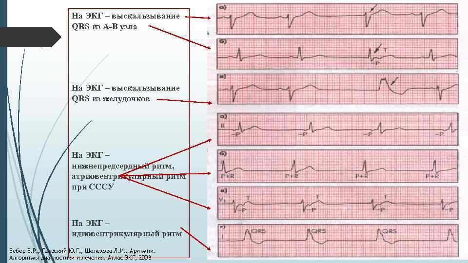 На ЭКГ – выскальзывание QRS из А-В узла На ЭКГ – выскальзывание QRS из