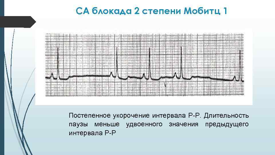 СА блокада 2 степени Мобитц 1 Постепенное укорочение интервала Р-Р. Длительность паузы меньше удвоенного
