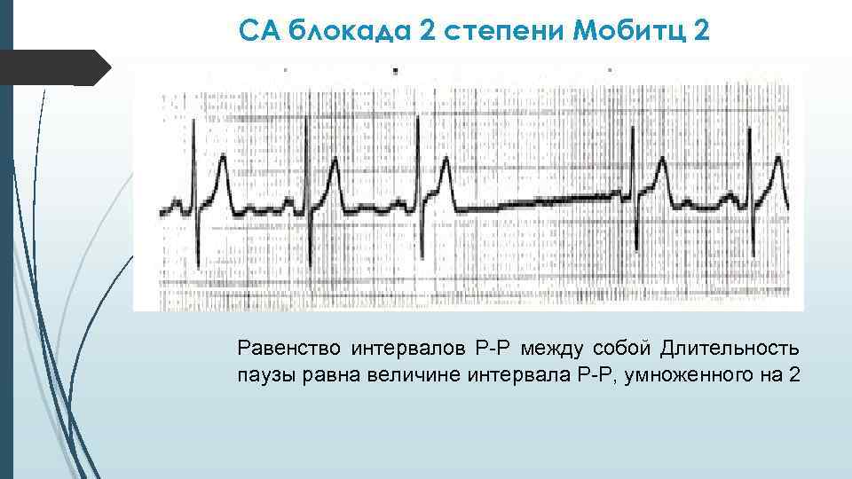 СА блокада 2 степени Мобитц 2 Равенство интервалов Р-Р между собой Длительность паузы равна