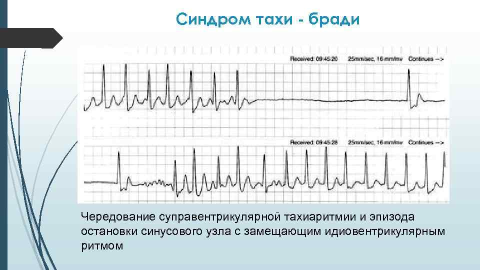Синдром тахи - бради Чередование суправентрикулярной тахиаритмии и эпизода остановки синусового узла с замещающим