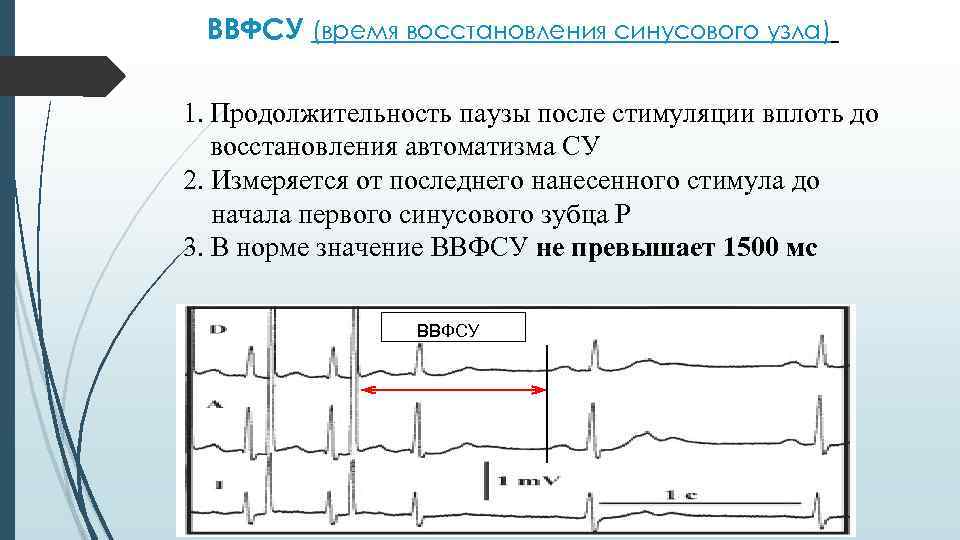 ВВФСУ (время восстановления синусового узла) 1. Продолжительность паузы после стимуляции вплоть до восстановления автоматизма
