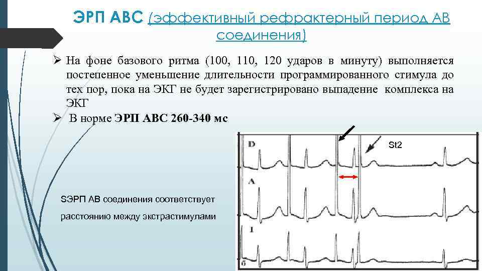 ЭРП АВС (эффективный рефрактерный период АВ соединения) Ø На фоне базового ритма (100, 110,