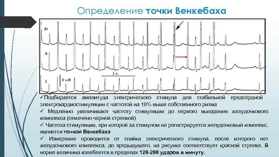 Определение точки Венкебаха üПодбирается амплитуда электрического стимула для стабильной предсердной электрокардиостимуляции с частотой на