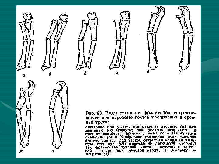 Закрытый перелом лучевой кости карта вызова