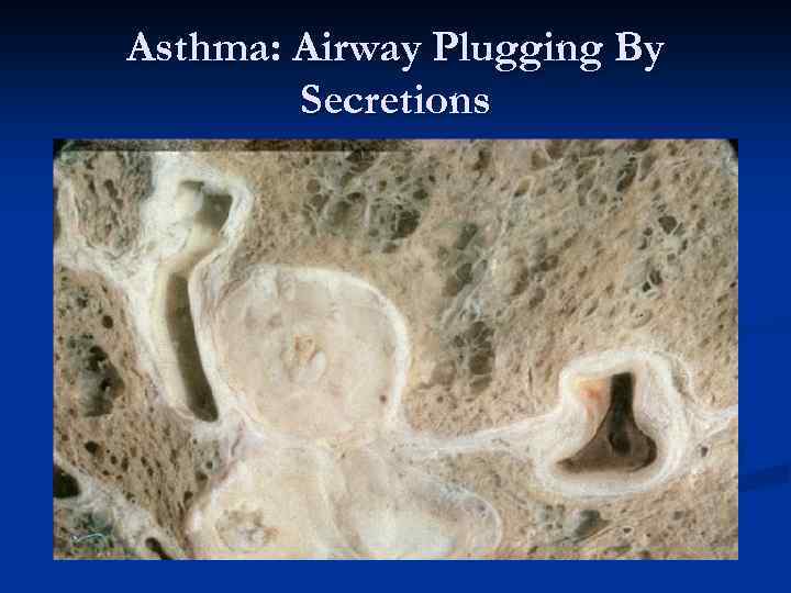 Asthma: Airway Plugging By Secretions 
