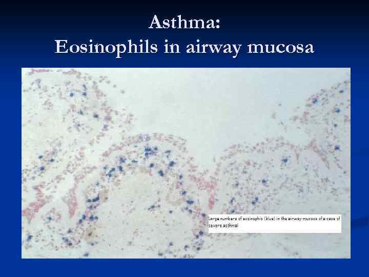Asthma: Eosinophils in airway mucosa 