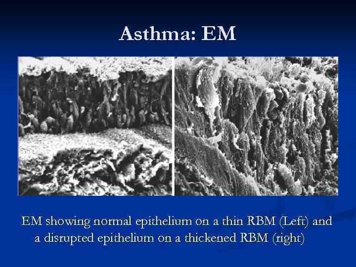 Asthma: EM EM showing normal epithelium on a thin RBM (Left) and a disrupted