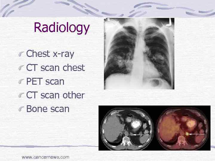 Radiology Chest x-ray CT scan chest PET scan CT scan other Bone scan www.