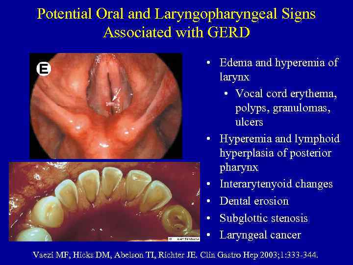 Potential Oral and Laryngopharyngeal Signs Associated with GERD • Edema and hyperemia of larynx