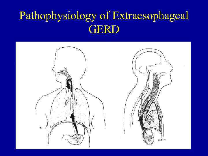 Pathophysiology of Extraesophageal GERD 