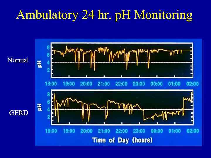 Ambulatory 24 hr. p. H Monitoring Normal GERD 