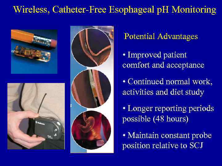 Wireless, Catheter-Free Esophageal p. H Monitoring Potential Advantages • Improved patient comfort and acceptance