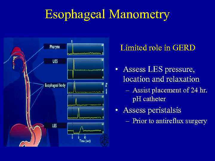 Esophageal Manometry Limited role in GERD • Assess LES pressure, location and relaxation –