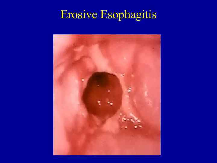 Erosive Esophagitis 