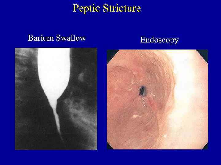 Peptic Stricture Barium Swallow Endoscopy 