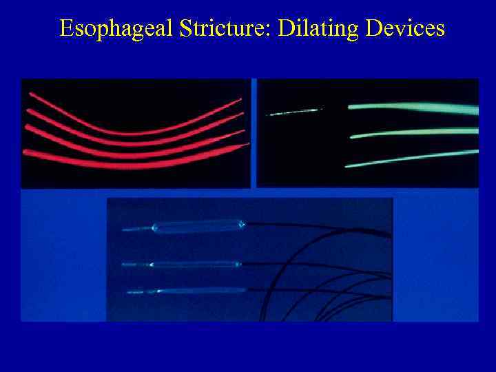 Esophageal Stricture: Dilating Devices 
