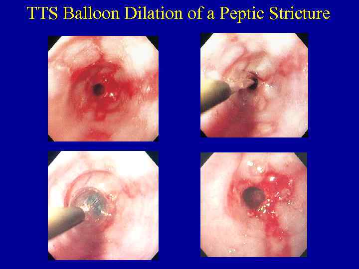 TTS Balloon Dilation of a Peptic Stricture 