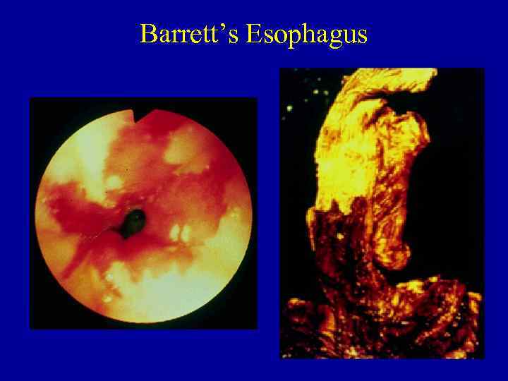 Barrett’s Esophagus 