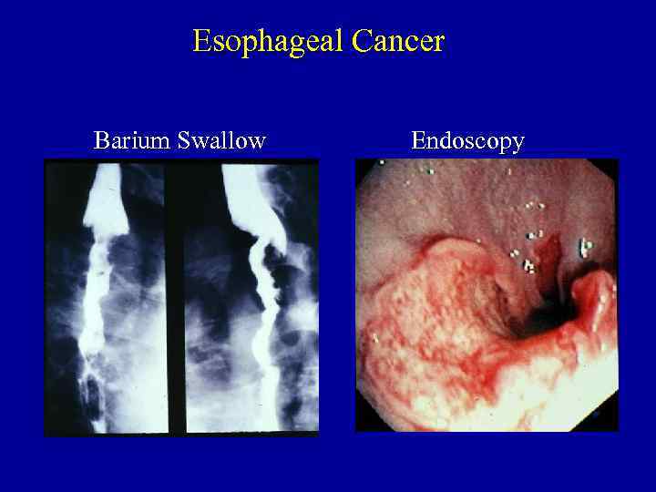 Esophageal Cancer Barium Swallow Endoscopy 