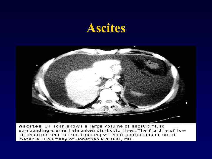Ascites 